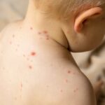 Measles Outbreak Spreads to Airports Over Holiday Travel Season