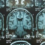 New COVID-Linked Brain Damage Evidence Has Scientists Worried